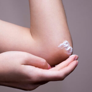 Atopic dermatitis – Causes, symptoms, and more